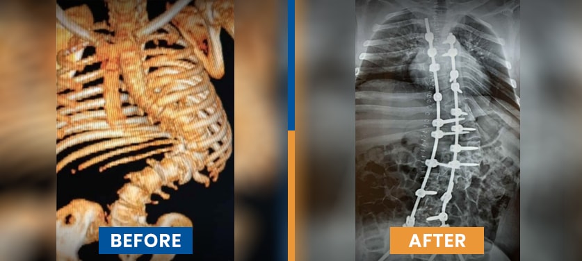 Scoliosis Surgery Before After